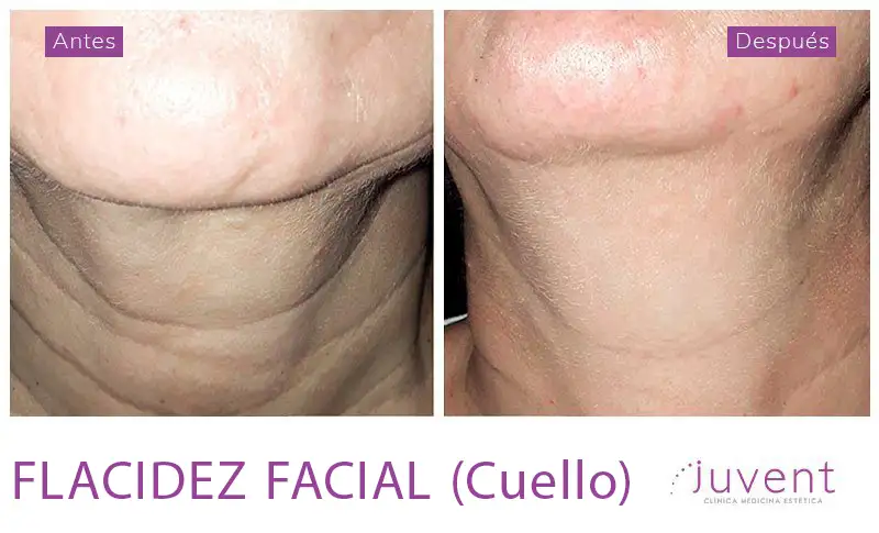 Hilos Tensores 03