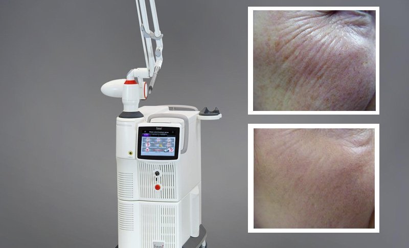 laser fotona dynamis elimina arrugas