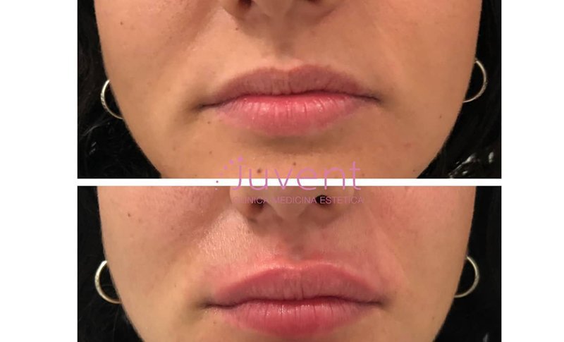 relleno labios acido hialuronico sin cirugia