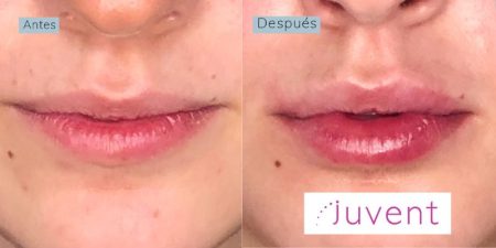 remodelación_labial