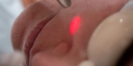 efecto-laser-fotona