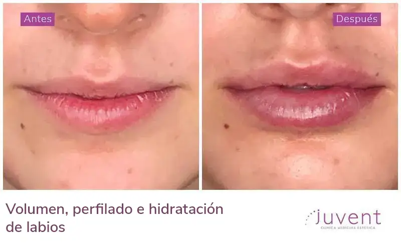 Volumen, perfilado e hidratación de labios 01