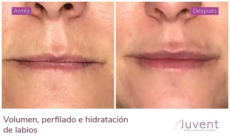 Volumen, perfilado e hidratación de labios 02