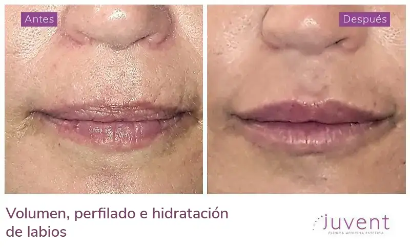 Volumen, perfilado e hidratación de labios 03