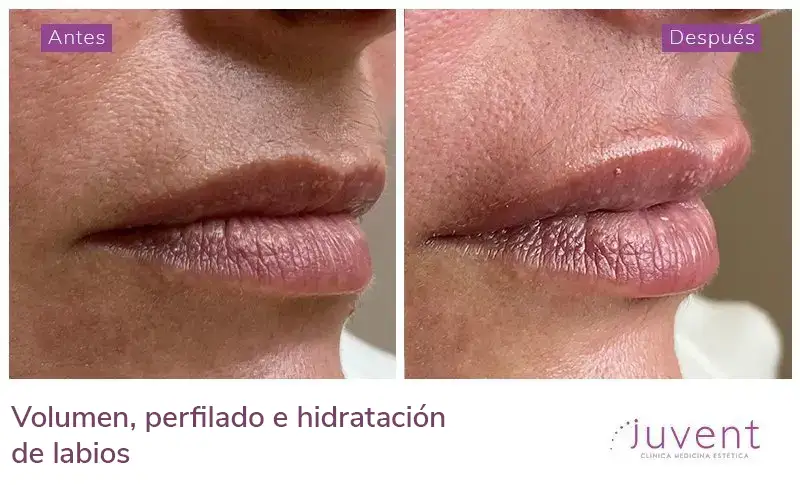 Volumen, perfilado e hidratación de labios 04
