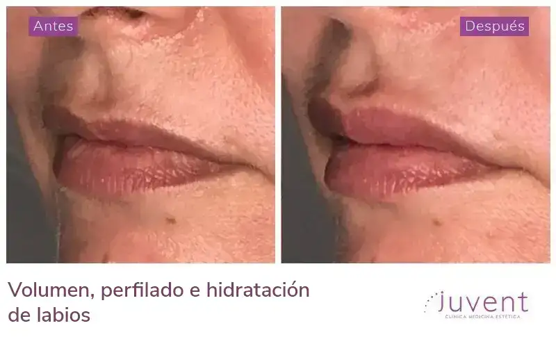 Volumen, perfilado e hidratación de labios 05